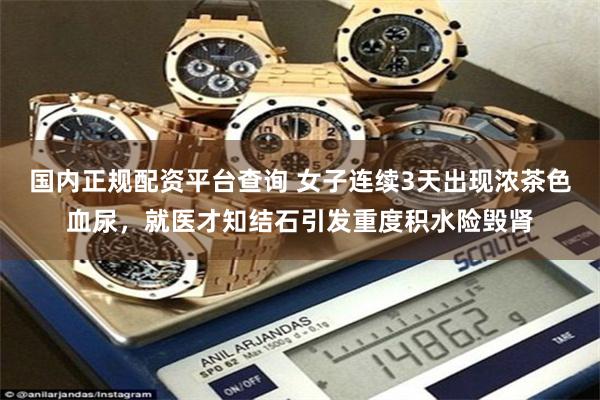 国内正规配资平台查询 女子连续3天出现浓茶色血尿，就医才知结石引发重度积水险毁肾